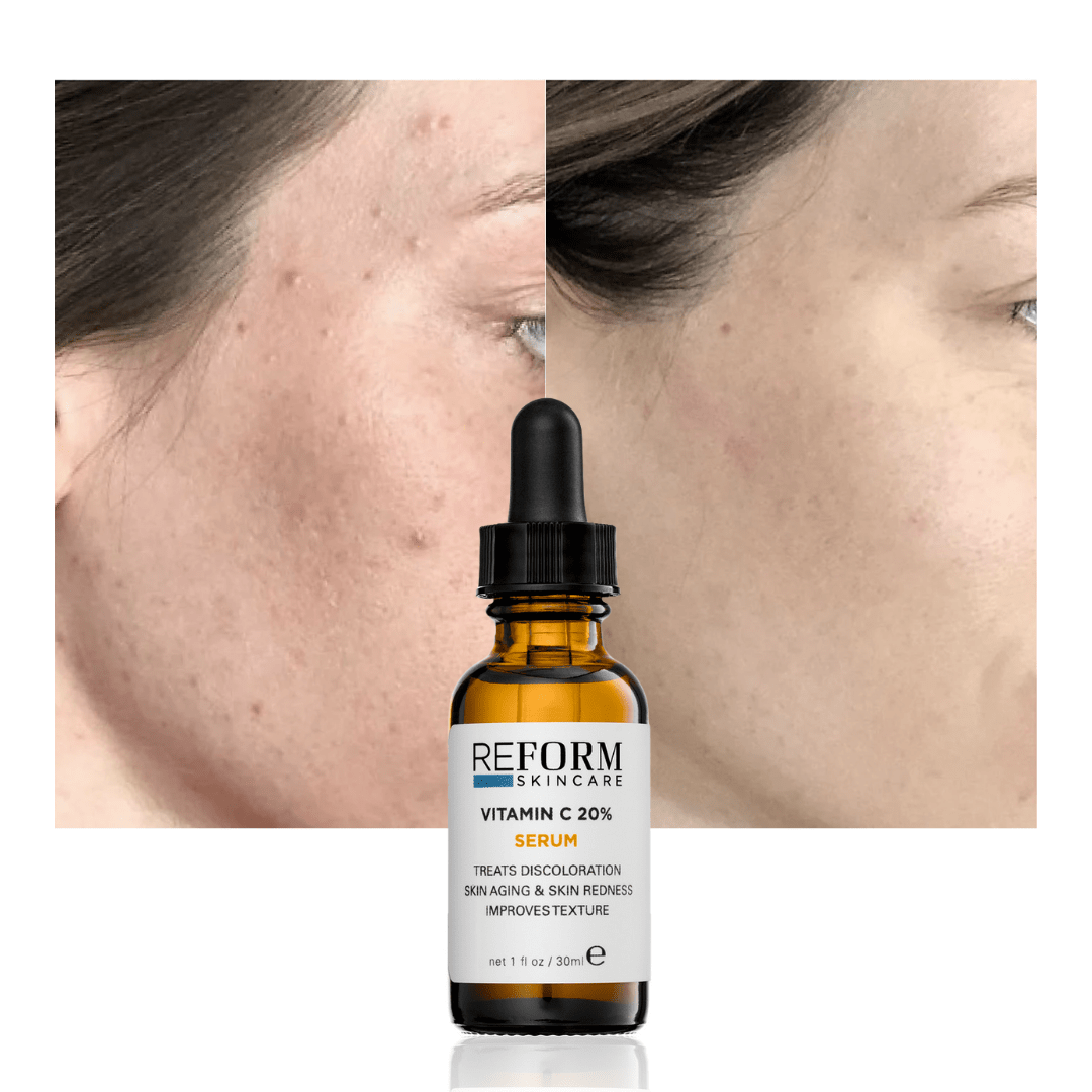 Decluttering Your Skincare Routine: The Power of Discoloration Serum